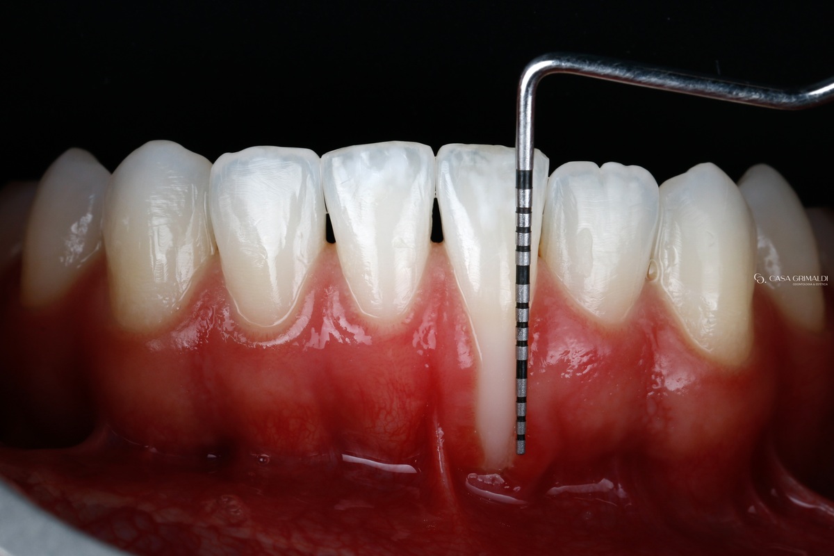 Sonda periodontal milimetrada encostada no incisivo inferior, medindo a parte da raiz exposta pela gengiva recuada.