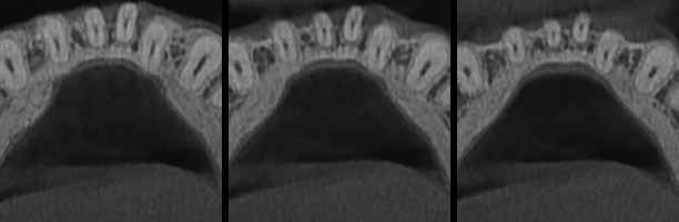 Três cortes horizontais da tomografia na altura das raízes dos dentes da frente de baixo.