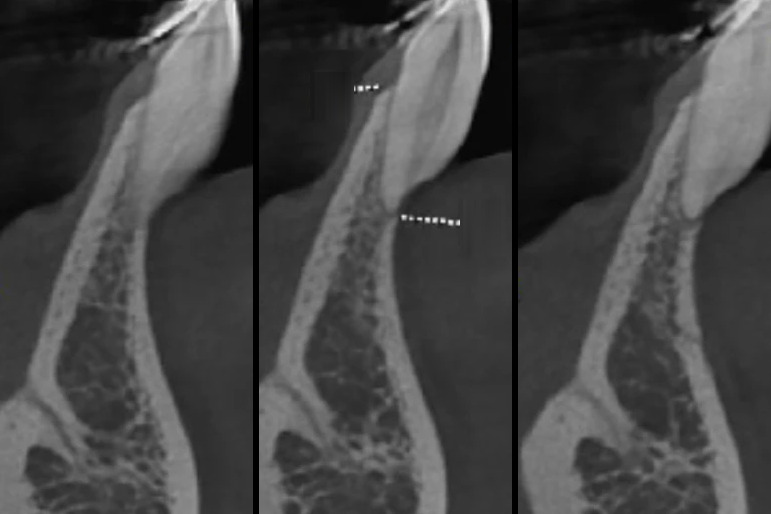 Corte de tomografia mostrando o incisivo inferior e o osso ao redor da raiz.