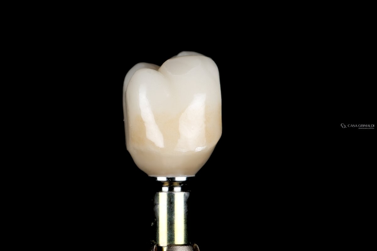 Implante dentário em Itapema — coroa cerâmica sobre pilar protético