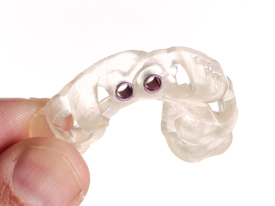 Guia cirúrgico de implante impresso em 3D, usado na cirurgia guiada na Casa Grimaldi, na Meia Praia, Itapema.