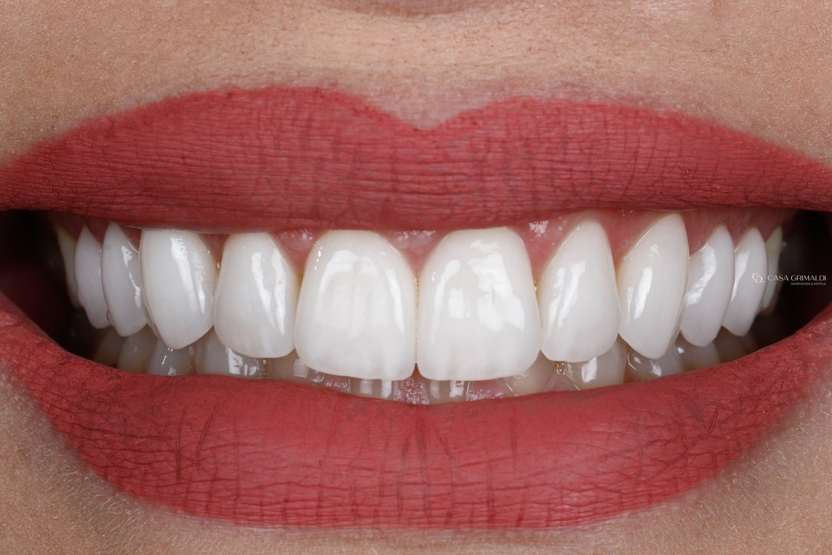 Sorriso de frente com lentes de cerâmica nos dentes superiores, cinco anos depois da cimentação