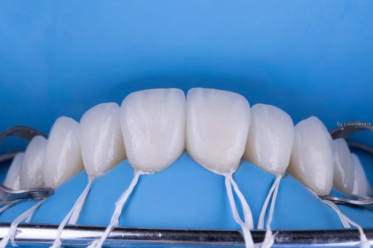 Lentes de cerâmica recém-cimentadas nos dentes superiores, com o lençol de borracha azul do isolamento e um fio amarrado em cada dente