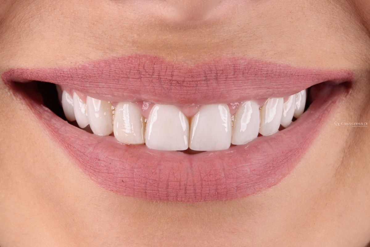 Sorriso de frente antes da troca das lentes de cerâmica