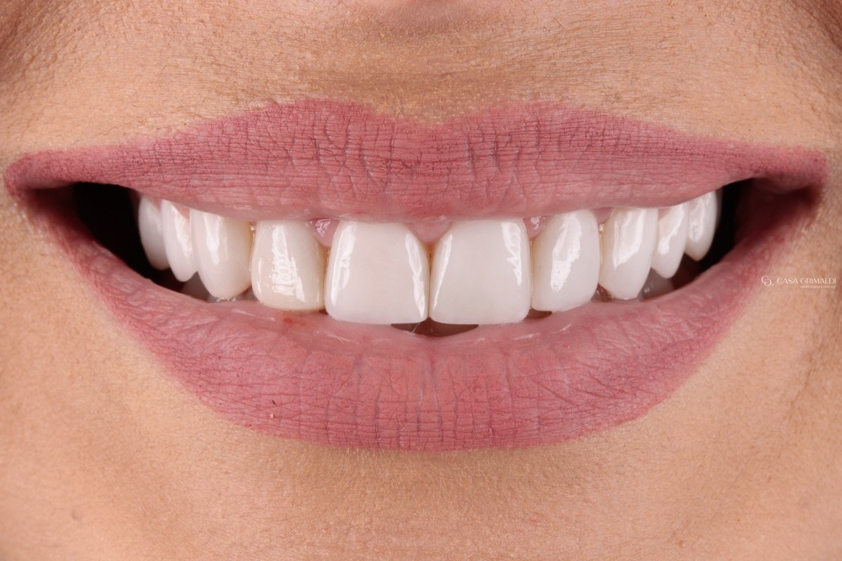 Sorriso em close, de frente, com as lentes de contato dental antigas, volumosas, nos dentes superiores, antes da troca