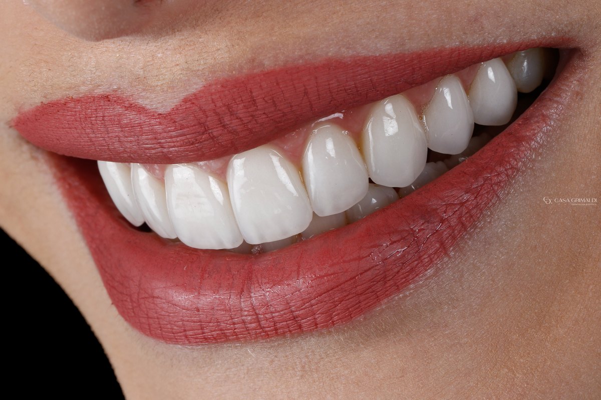Sorriso em close, de perfil, com lentes de porcelana nos dentes superiores cinco anos depois da troca