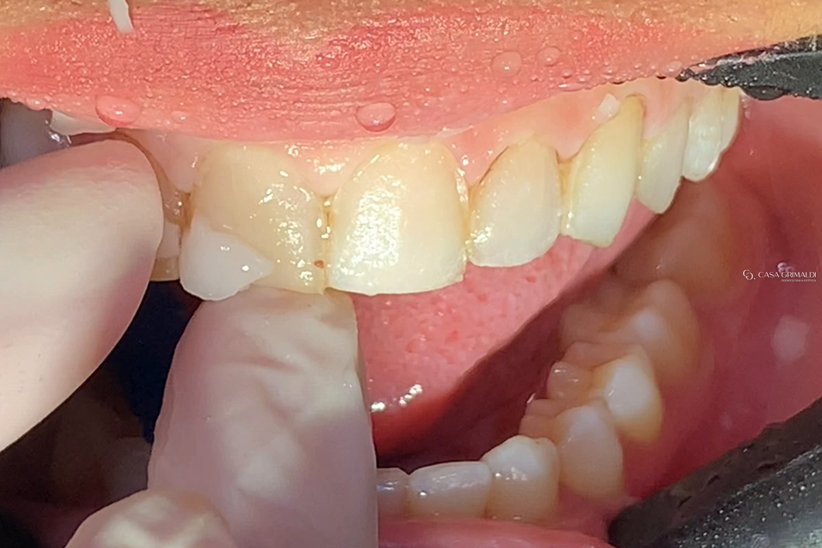 Dedos com luva segurando uma lente de contato dental que se solta do incisivo central superior durante a remoção com laser
