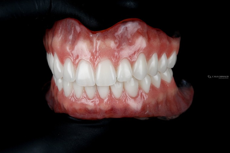 Prótese dentária em Itapema — peça finalizada com gengiva caracterizada